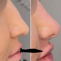 تزریقات، فیلر بوتاکس جوانسازی و جراحی‌های تخصصی|خدمات آرایشگری و زیبایی|اهر, |دیوار