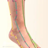 درمان زانو درد و کمردرد با امبدینگ