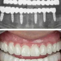 دندانپزشکی،ایمپلنت، اوردنچر|خدمات آرایشگری و زیبایی|مرند, |دیوار