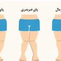 کلینیک درمان زانوهای پرانتزی و ضربدری