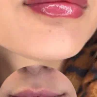 بوتاکس