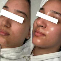 پاکسازی تخصصی پوست صورت|خدمات آرایشگری و زیبایی|اصفهان, فرح آباد|دیوار