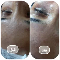 فیشال و پاکسازی پوست