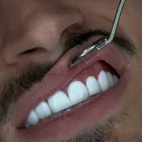 جشنواره کامپوزیت لمینیت روکش عصب ترمیم IMAX IPS|خدمات آرایشگری و زیبایی|تهران, هفت حوض|دیوار