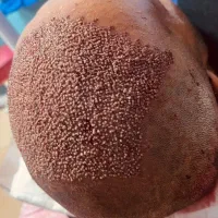 کاشت ابرو بلفاروپلاستی و کاشت مو از 10 ملیون
