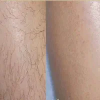 لیزر موهای زائد،سایناشور الیت پلاس ۲۰۲۵، ریزش فوری