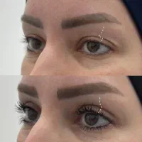 بلفاروپلاستی جراحی بلفارو پلاستی پلک بالا و پایین