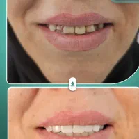 ایمپلنت بلندمدت/کامپوزیت/لمینت/درمانی|خدمات آرایشگری و زیبایی|مرند, |دیوار