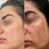 کرم ضدلک و‌جوش و سفید کننده|آرایشی، بهداشتی، درمانی|دهدشت, |دیوار