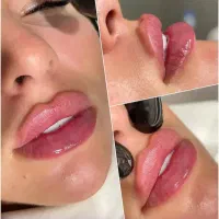 بوتاکس فیلر ژل