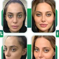 بوتاکس فیلر لاغری هایفو لیزر ساکشن ژل prp نخ خال