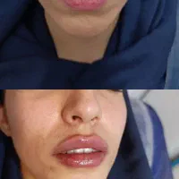 کانتورینگ و زاویه سازی،ژل لب و بوتاکس کاملا اقساطی|خدمات آرایشگری و زیبایی|قم, بکایی|دیوار