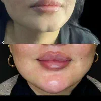 مرکز تخصصی ژل بوتاکس /کاشت امبدینگ لاغری در مطب|خدمات آرایشگری و زیبایی|کرمانشاه, |دیوار