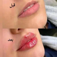 تخفیف ویژه اموزش تزریق بوتاکس و فیلر|خدمات آموزشی|ارومیه, |دیوار