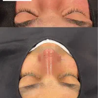 جشنواره عمل بینی به سبک جراحان ترکیه|خدمات آرایشگری و زیبایی|لامرد, |دیوار