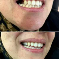 دندان مصنوعی و دندانسازی ، خدمات دندان سازی|خدمات آرایشگری و زیبایی|مشهد, شفا|دیوار