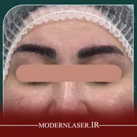 ریموو انواع تتو و خالکوبی بدون هیچ اثری توسط پزشک|خدمات آرایشگری و زیبایی|اصفهان, سعادت‌آباد|دیوار