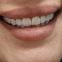 ایمپلنت اقساطی عصبکشی روکش لمینت دندانپزشکی قسطی