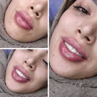 تخفیف ویژه خدمات ژل و بوتاکس|خدمات آرایشگری و زیبایی|زابل, |دیوار