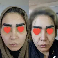 ژل،بوتاکس،مزو،چال لپ،فیلر|خدمات آرایشگری و زیبایی|قم, عمار یاسر|دیوار