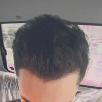 کاشت مو و ابرو قسطی در شیراز|خدمات آرایشگری و زیبایی|شیراز, قصرالدشت|دیوار