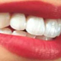 دندانپزشکی ،کامپوزیت، لبخندت زیباست، دم قسط،تضمینی