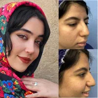 جراحی بینی باقیمت ویژه، با روش پیزوسرجری