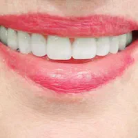 دندانسازی دندان مصنوعی|خدمات آرایشگری و زیبایی|مشهد, اقبال|دیوار
