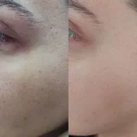 حذف لک و منافذ باز و جای جوش/زیر نظر متخصص پوست|خدمات آرایشگری و زیبایی|مشهد, الهیه|دیوار
