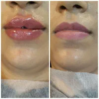 ژل بوتاکس فقط ۷۰۰|خدمات آرایشگری و زیبایی|مشهد, فرهنگ|دیوار