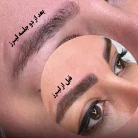 پاک کردن تتو با لیزر کیوسوییچ تضمینی|خدمات آرایشگری و زیبایی|تهران, نیروی هوایی (پیروزی)|دیوار