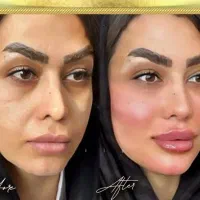 جشنواره تزریق ژل،فیلر،بوتاکس باقیمت کم هفده شهریور|خدمات آرایشگری و زیبایی|تبریز, |دیوار
