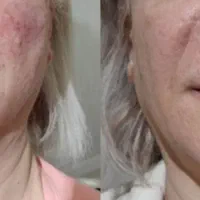 لیزر موهای زائد،ژل،بوتاکس،فیشال،پاک کردن تتو|خدمات آرایشگری و زیبایی|کرج, فاز ۴ مهرشهر|دیوار