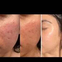 لک صورت بوتاکس خال موی سر ریش|خدمات آرایشگری و زیبایی|اهواز, کیان اباد|دیوار