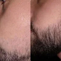 دوره 30 روزه رویش مجدد ریش و سیبیل