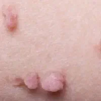 با زگیل هات برای همیشه خداحافظی کن