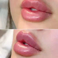 ژل بوتاکس مزو