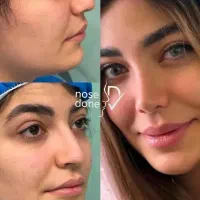 عمل بینی ( فقط ۳۱میلیون)|خدمات آرایشگری و زیبایی|بوئین و میاندشت, |دیوار