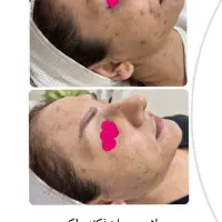 فیشال تخصصی و درمانی صورت و بدن، رفع تیرگی چیتگر|خدمات آرایشگری و زیبایی|تهران, گلستان (شهرک راه آهن)|دیوار