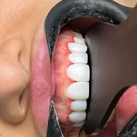 کامپوزیت و لمینت دندان