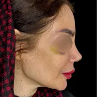 عمل جراحی بینی توسط متخصص زیباییent/ترمیم بینی|خدمات آرایشگری و زیبایی|کرج, چهارصد دستگاه|دیوار