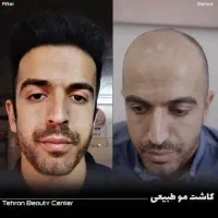 کلینیک فوق تخصصی/کاشت مو / ابرو|خدمات آرایشگری و زیبایی|زاهدان, |دیوار