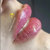 خدمات تزریق فیلر صورت بوتاکس مزوتراپی ولیزر|خدمات آرایشگری و زیبایی|نسیم‌شهر, |دیوار