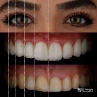 *لمینیت*کامپوزیت*بلیچینگ* قسطی خدمات دندان پزشکی