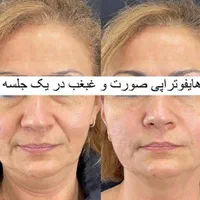 هایفوتراپی|خدمات آرایشگری و زیبایی|اصفهان, هزارجریب|دیوار