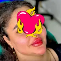 تزریق تخفیف ویژه تابستانه فیلروبوتاکس