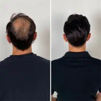 کاشت سر و کاشت ابرو در جشنواره با قیمت عالی|خدمات آرایشگری و زیبایی|تهران, اباذر|دیوار