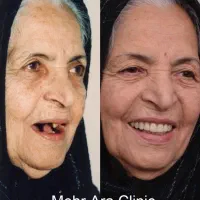 ایمپلنت با روکش هدیه 12.600 محدود|خدمات آرایشگری و زیبایی|تهران, ستارخان|دیوار