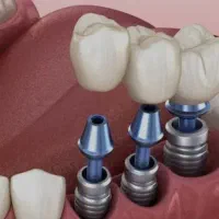 دندانپزشکی زهره خزانه جنوب تهران