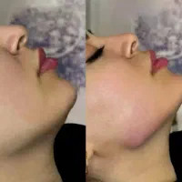 ژل و بوتاکس تخصصی و کاشت مو و ابرو